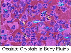 High Oxalates Foods: Much More than just Kidney Stone Risk