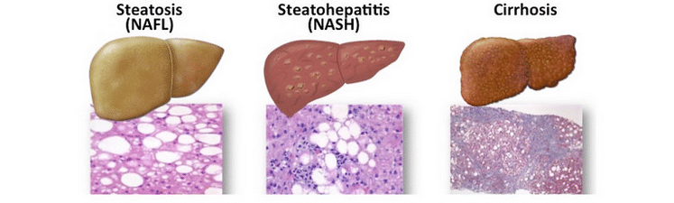 Fatty Liver and Dementia